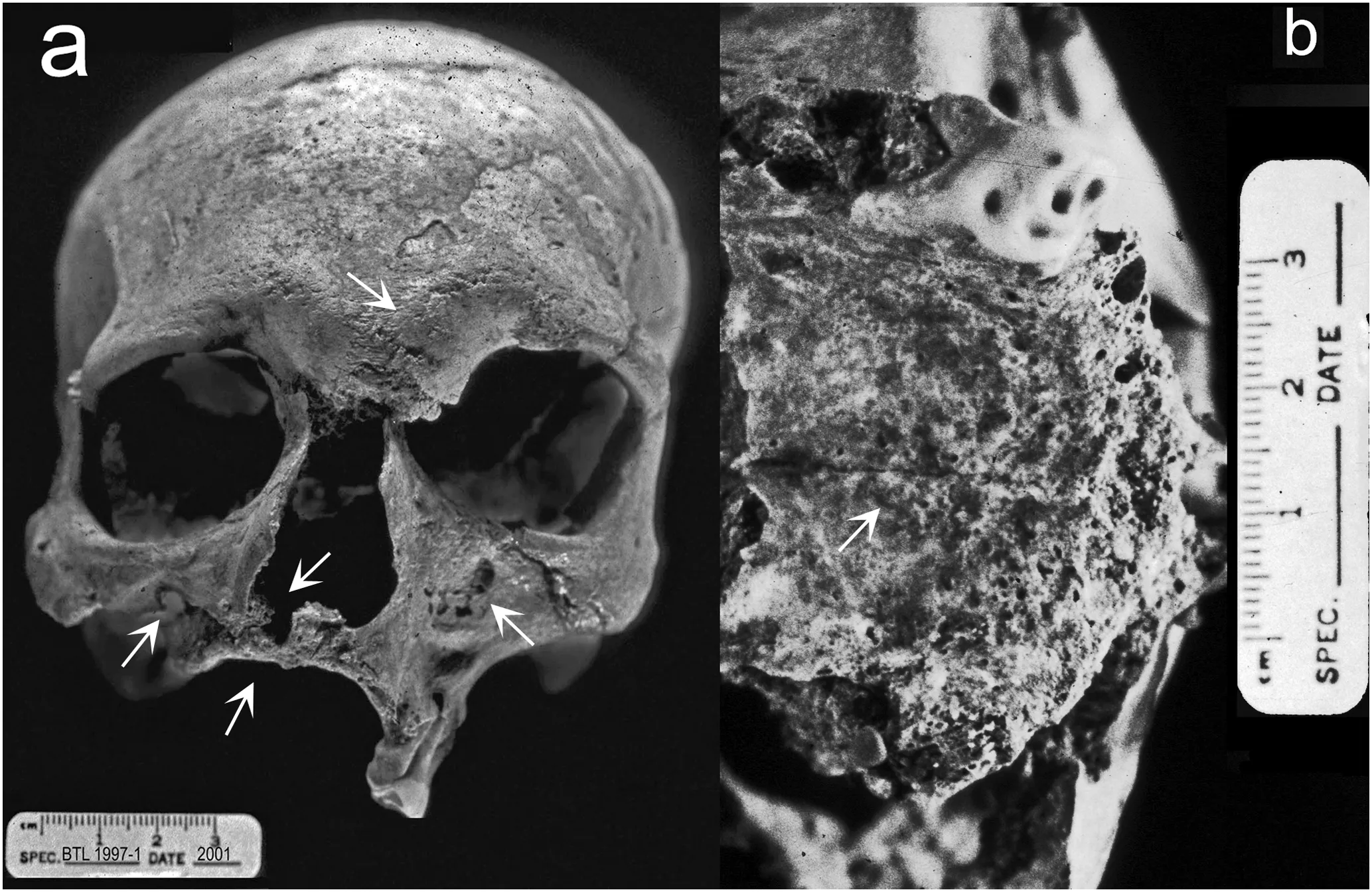 Skeletal remains from Balithal, Rajasthan